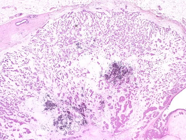 Imaging modality: light microscopy of formalin-fixed, paraffin-embedded breast tissue stained with Hematoxylin and Eosin (H&E). The specimen shows a fibroadenomatous lesion in which malignant mucinous (colloid) carcinoma arises within the epithelial component. The histology demonstrates abundant extracellular mucin pools with floating or discohesive malignant epithelial cells arranged in small clusters and glands. The surrounding stroma resembles a fibroepithelial lesion consistent with a longstanding fibroadenoma, but focal invasion by mucinous carcinoma is evident at the periphery, with cells displaying low to intermediate nuclear grade, mild pleomorphism, and mitotic activity. The mucin pools are typically large and may displace adjacent ducts, with signet ring-like morphology occasionally observed in mucin-producing cells. Immunohistochemical profile (not shown) would typically reveal cytokeratin positivity in tumor cells; myoepithelial layer is diminished at invasive fronts, supporting invasion beyond the fibroadenoma capsule. Clinically, this reflects a rare malignant transformation of a benign fibroepithelial lesion, reported to occur in approximately 0.1% of fibroadenomas, with the majority of malignant cases previously described as in-situ, while invasive mucinous carcinoma arising in a fibroadenoma carries implications for surgical management and prognosis. This image is educational for recognition of carcinoma arising within benign breast lesions, illustrating the need for complete excision and careful histologic assessment of invasion.