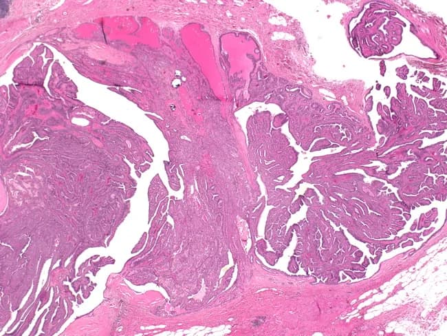 Imaging modality: light microscopy; specimen type: breast ductal tissue; technique: hematoxylin and eosin staining. The slide demonstrates a 1.5 cm intraductal papilloma arising within a central/subareolar duct with a palpable mass and associated bloody nipple discharge clinically. Histologically, the lesion consists of multiple papillary fronds protruding into a dilated duct lumen, each frond supported by a fibrovascular core and lined by a dual epithelial and myoepithelial layer. The epithelial component is typically columnar to cuboidal with uniform nuclei and minimal cytologic atypia; myoepithelial cells encircle the papillae, helping to distinguish benign intraductal papilloma from invasive carcinoma. The surrounding ductal epithelium shows mild ductal ectasia and focal hyperplasia but lacks invasion, high-grade atypia, or marked mitotic activity. The architecture is characteristic of benign papillary lesions of the breast, though larger papillomas can be solitary and clinically present as subareolar masses with Bloody discharge. The lesion may be associated with ductal dilation and mild stromal inflammation; no necrosis or stromal desmoplasia is evident. Clinically, this finding correlates with nipple discharge spectrum (bloody) and mass effect; management typically involves surgical excision to rule out atypia or malignant transformation and ensure complete removal of the papillary lesion.