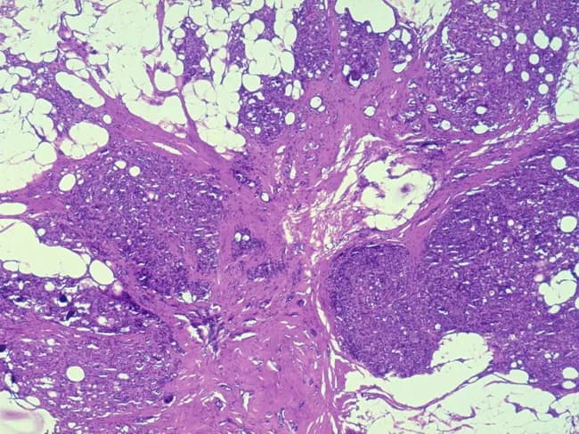 Breast tissue histology obtained by surgical biopsy demonstrating a radial scar (complex sclerosing lesion) with associated ductal hyperplasia. The lesion features a central densely fibrotic core with radiating strands of oriented, compressed ducts embedded in fibrous and myxoid stroma. Ductal epithelium shows hyperplastic changes consistent with mild ductal hyperplasia; there is no overt cytologic atypia or invasion observed. The overall architecture resembles a starburst lesion on gross imaging but is evaluated here on hematoxylin-eosin stained sections at multiple magnifications (4x–40x). The fibrous stroma is variably hyalinized, with entrapped glands that may be distorted in a stellate configuration. The differential diagnosis includes tubular carcinoma and other sclerosing lesions; however, the absence of infiltrative growth and high-grade cytology supports a benign radial scar, though associations with occult or nearby carcinoma have been reported. Clinically, radial scars larger than 1 cm carry an increased risk of carcinoma development, particularly tubular carcinoma, and surgical excision or close radiologic-pathologic correlation is advised for larger lesions or those with atypia. This image is relevant for pathology education, radiologic-pathologic correlation, differential diagnosis training, and risk-stratified breast lesion assessment in a diagnostic pathology workflow. Correlate with imaging features and patient age to guide management decisions in clinical practice.