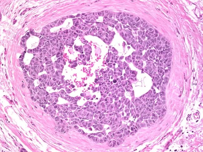 Histopathology slide of breast tissue; transverse cross-section through a breast duct; densely packed neoplastic ductal epithelial cells fill the lumen; cells exhibit high nuclear grade with marked pleomorphism, hyperchromasia, conspicuous nucleoli; the cytoplasm is relatively abundant and borders are sharply demarcated. The epithelial proliferation forms solid/cribriform arrangements; the surrounding basement membrane appears intact; there is no obvious stromal invasion. Central luminal material may show eosinophilic debris consistent with necrosis in some ducts. The tissue architecture is characteristic of ductal carcinoma in situ, high-grade subtype. Diagnostic significance: Non-invasive precursor lesion with potential progression to invasive cancer; high-grade DCIS carries higher risk and often requires surgical excision with clear margins and consideration of radiotherapy; may be associated with microcalcifications on imaging. Differential considerations: low-grade DCIS, cribriform or comedo patterns, invasive ductal carcinoma without invasion; lobular neoplasia unlikely due to ductal architecture; clinical correlation with mammography and breast imaging is essential. Clinical use cases: pathology teaching slides, diagnostic review, AI training for histopathology DCIS recognition, radiologic-pathologic correlation, surveillance planning. Expressed terms include intraductal, ductal carcinoma in situ, high-grade, solid, cribriform, pleomorphic; emphasizes need for margin assessment and multidisciplinary review.