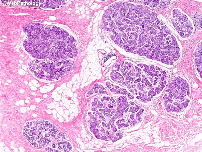 Imaging modality and technique: Light microscopy of hematoxylin and eosin stained formalin-fixed paraffin-embedded breast tissue. The field shows terminal duct-lobular units with lobules distended by uniform, medium-sized cells. Cells are noncohesive, with round to oval nuclei and minimal cytoplasm; chromatin is evenly distributed and nucleoli are inconspicuous. The architecture is intralobular, with proliferation confined to lobular acini and frequent preservation of the basement membrane, indicating lobular carcinoma in situ (LCIS). Involved lobules are expanded and packed with these cells, while an uninvolved lobule remains in the specimen. The lobular lesions are typically multicentric, as evidenced by multiple foci of LCIS in the same tissue fragment. Associated stroma is generally not desmoplastic, and there is no invasion into surrounding breast parenchyma. The appearance is consistent with classic LCIS: a diffuse, noninvasive proliferation that can be multicentric and bilateral in many cases. This histology correlates with the clinical concept that LCIS confers an elevated risk of subsequent breast carcinoma rather than an immediate invasive lesion. Recognition of this pattern is essential to distinguish LCIS from ductal carcinoma in situ and invasive lobular carcinoma, guiding surveillance strategies and chemoprevention decisions. Clinical implications include close radiologic surveillance and consideration of chemoprevention in high-risk patients.