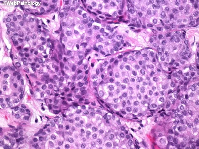 Brightfield histopathology image of breast tissue stained with hematoxylin and eosin (H&E). The specimen shows lobular units filled by small, uniform cells with round to oval nuclei, inconspicuous nucleoli, and scant cytoplasm. Cells are discohesive and expand the terminal duct-lobular units without forming ductal structures, a characteristic pattern of lobular carcinoma in situ (LCIS). In this case, classic LCIS is observed without cytologic atypia, pleomorphism, increased mitotic activity, or necrosis; features that would otherwise designate pleomorphic LCIS when present alone or in combination. The architecture remains confined to lobules with preservation of basement membrane and no evidence of stromal invasion. Background breast parenchyma shows mild fibrous stroma and occasional benign ductal hyperplasia. The image emphasizes in-situ proliferation of mammary epithelial cells that express loss of cohesion and a monomorphic cytologic appearance. Clinically, classic LCIS indicates a marker of increased risk for concurrent or subsequent breast carcinoma in either breast and may influence surgical and surveillance management. Diagnostic significance lies in distinguishing classic LCIS from pleomorphic LCIS and from other in-situ or invasive lesions such as ductal carcinoma in situ (DCIS). This histologic pattern underscores the importance of careful histopathologic assessment and correlates with imaging and clinical risk assessment.