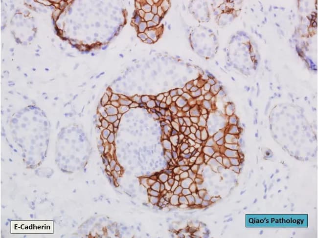 This immunohistochemistry slide of breast tissue was prepared for E-cadherin staining and captured by brightfield microscopy at high magnification. The specimen shows a ductal compartment containing ducts with cohesive epithelial cells consistent with ductal carcinoma in situ (DCIS) that demonstrate strong membranous brown staining for E-cadherin. Adjacent lobular-type cellular nests show absent or markedly reduced E-cadherin staining, compatible with lobular carcinoma in situ (LCIS). Notably, one duct exhibits a hybrid region in which both DCIS and LCIS phenotypes are present within the same duct, illustrating intraductal heterogeneity. The DCIS component forms well-defined, angulated outlines; the LCIS component is less cohesive, with smaller, uniform cells and loose cell packing. The staining pattern confirms the differential adhesion molecule expression between ductal and lobular neoplasia. Clinically, E-cadherin immunostaining is critical for accurate classification of in situ lesions, guiding surveillance, surgical margins, and adjuvant therapy decisions. This image is valuable for educational comparisons of DCIS versus LCIS morphology and for research on combined in situ phenotypes, clonal relationships, and diagnostic workflows in breast pathology. It may aid differential diagnosis against invasive carcinoma and aid optimization of pathology reporting and multidisciplinary management. Clinical correlation with imaging findings and margin status should be integrated into reporting.