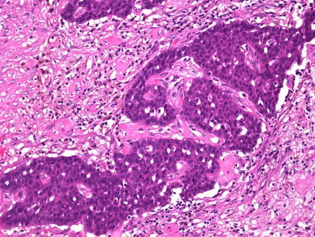 Imaging modality: bright-field light microscopy of hematoxylin and eosin–stained breast tissue section; high-quality histology slide prepared from a surgical pathology specimen. Anatomical focus: invasive papillary carcinoma of the breast with tumor cells forming arborizing papillary fronds and invading adjacent desmoplastic stroma. Precise localization within mammary gland ducts and lobules, showing extension beyond the tumor borders and evidence of stromal desmoplasia, inflammation, and fibrotic change. Cellular morphology includes malignant epithelial cells with vesicular to hyperchromatic nuclei, conspicuous nucleoli, and mitotic activity distributed throughout papillary cores and surrounding nests. Fibrovascular cores within papillary structures are embedded in a collagen-rich, reactive stroma; hemorrhage and scar-like fibrosis are variably present in areas of postbiopsy change. Notable features indicating invasion include disruption of basement membrane continuity and penetration into adjacent breast parenchyma. Diagnostic significance lies in differentiating in situ from invasive disease and in informing staging (T stage) and prognosis; the desmoplastic reaction supports invasive behavior. Differential considerations include papillary in situ carcinoma with invasion-like features, invasive ductal carcinoma with papillary morphology, and benign papillary lesions with reactive stroma. Clinically relevant applications encompass surgical planning (wide excision vs mastectomy), adjuvant therapy decisions, and correlation with radiologic findings for comprehensive cancer management. Educational value for teaching.