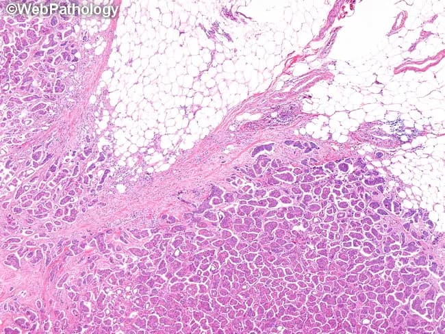This histopathology image is a hematoxylin and eosin stained paraffin-embedded breast tissue section examined under light microscopy. The primary subject is micropapillary carcinoma (MPC) of the breast, an aggressive variant of invasive ductal carcinoma, frequently presenting as a palpable mass in the upper outer quadrant and often associated with nodal metastases. The visual architecture shows cohesive tumor cell clusters arranged in micropapillary, tubular-alveolar, and morular patterns embedded within lacunar spaces that resemble lymphovascular channels. The tumor nests are small-to-medium in size, with high nuclear grade, enlarged, pleomorphic nuclei, conspicuous nucleoli, and brisk mitotic activity; cytoarchitecture demonstrates reverse polarity with apical-like cell surfaces facing the lacunar spaces. Adjacent benign or fibroadipose breast tissue is present, with conspicuous desmoplastic stroma at the invasive front. Microcalcifications may be detected radiographically; however, in this histology image, calcifications are not visualized. The image highlights the diagnostic hallmarks of MPC: micropapillary clusters, lacunar spaces, and a propensity for nodal/distant spread. Clinically, this variant portends a worse prognosis than conventional invasive ductal carcinoma, ductal NOS, underscoring the need for precise histologic subclassification, thorough sentinel lymph node assessment, and consideration of systemic therapy in management planning for pathology.