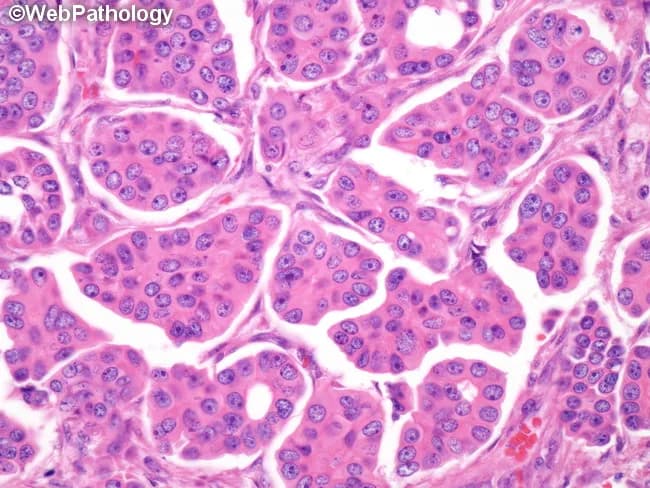 Comprehensive Description: Histopathology image of breast tissue illustrating invasive micropapillary carcinoma with accompanying ductal carcinoma in situ (DCIS). This bright-field micrograph was produced from Hematoxylin and Eosin stained sections of formalin-fixed, paraffin-embedded tissue and viewed under high-power magnification (approximate 400x total). The primary breast lesion is localized to the mammary gland with nests and clusters of malignant epithelial cells forming micropapillary fronds, tubuloalveolar, or morular configurations. Clusters are surrounded by conspicuous lacunar spaces that mimic lymphovascular channels, a pattern that frequently overcalls vascular invasion; true lymphovascular invasion is commonly present. Tumor cells exhibit moderate eosinophilic cytoplasm, high-grade nuclear pleomorphism, and frequent mitotic figures. Notably, the cells display reverse polarity, with apical surfaces facing the surrounding stroma; desmoplastic stroma supports invasive growth. Microcalcifications are commonly observed in association with in situ components. DCIS of micropapillary and cribriform types is often present adjacent to the invasive component. Clinically, this histology portends a higher risk of nodal metastasis and recurrence, guiding axillary staging and adjuvant therapy decisions. Radiologic-pathologic correlation is aided by mammographic calcifications and ultrasound features; management implications include surgical planning, sentinel lymph node assessment, and systemic therapy consideration. This image serves educational and research purposes for tumor morphology and diagnostic pattern recognition.