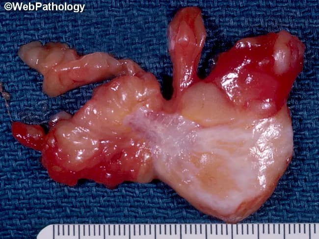 Gross pathology photograph of a breast tumor mass demonstrating invasive ductal carcinoma features. The specimen shows an irregular, often stellate or nodular mass with variable consistency due to desmoplastic stroma; firm to hard in desmoplastic-dominated areas and soft or cystic when extensive necrosis or hemorrhage is present. Gray-white fibrous strands radiate into adjacent fat, with focal yellow-white necrotic streaks and occasional hemorrhagic foci. The tumor margins may be indistinct or well-circumscribed in discrete sections, reflecting a mix of infiltrative and circumscribed growth patterns. Such stellate, infiltrative gross morphology is associated with larger size at presentation, higher likelihood of necrosis, and increased risk of axillary lymph node metastasis, imparting a poorer prognosis relative to circumscribed lesions. Microcalcifications—not always visible grossly—can influence gross texture by imparting a gritty consistency. The gross appearance underscores tumor heterogeneity, sampling considerations for histology, and clinical staging implications. This image supports education on gross features of breast invasive ductal carcinoma, grossing technique, and correlation with radiologic-pathologic findings in diagnostic practice. The description facilitates searchability by including synonyms (invasive ductal carcinoma, breast cancer), descriptive descriptors (stellate margins, desmoplasia, necrosis, hemorrhage, cystic change), and prognostic cues (size, invasion, nodal tendency) valuable for clinicians, educators, and researchers in pathology practice.