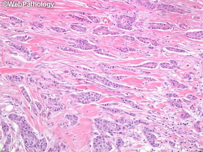 Histology section examined under light microscopy after Hematoxylin and Eosin staining of breast tissue. The specimen shows invasive ductal carcinoma with glandular/tubular differentiation. Tubule formation occupies approximately 30–40% of the tumor, corresponding to a Nottingham score of 2 for tubule formation. Nuclear grade and mitotic rate are not provided in this description. The histology reveals invasive nests of polygonal cells with pleomorphic, hyperchromatic nuclei set in desmoplastic stroma. Central lumina are present within tubulo-glandular structures, supporting ductal morphology. The tumor infiltrates surrounding parenchyma and disrupts normal architecture. This pattern indicates intermediate differentiation, consistent with Nottingham grade II. Morphologic heterogeneity may include focal solid areas coexisting with tubular elements. Clinically, intermediate grade tumors commonly have variable prognosis and treatment implications. Therapy decisions integrate receptor status (ER/PR/HER2), tumor size, nodal involvement, and proliferation index. Nottingham grading thus informs prognosis, guides adjuvant therapy, and supports educational interpretation of breast carcinoma histology. This image serves as a teaching resource for pathologists and trainees evaluating ductal neoplasia. The documented tubule-forming component highlights glandular differentiation and remains a salient correlate of tumor biology in breast cancer. In clinical practice, grading combines with receptor profiling to tailor therapies and estimate recurrence risk. Accurate histologic grade improves staging accuracy.