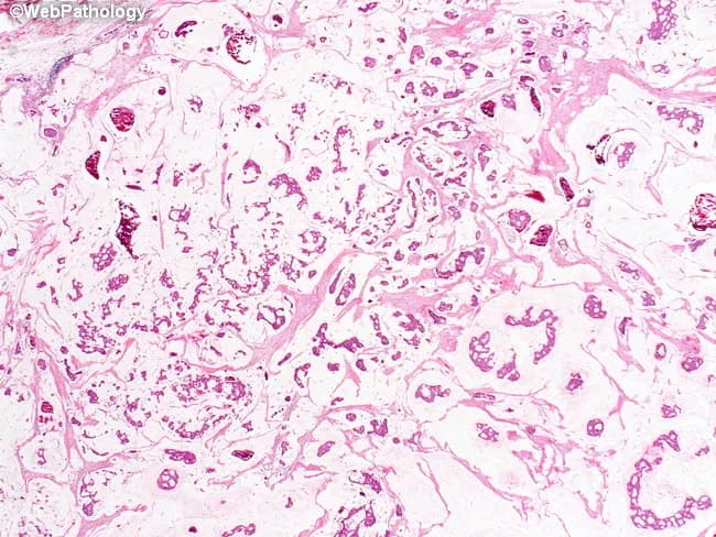 Imaging modality and technique: Light microscopy of formalin-fixed, paraffin-embedded breast tissue section stained with Hematoxylin and Eosin (H&E). Primary subject: mucinous (colloid) carcinoma of the breast. Location: breast parenchyma, mammary gland, invasive component within a mucinous matrix. Visual features: clusters and sheets of malignant epithelial cells dispersed within abundant extracellular mucin pools; mucin lakes with variable density; delicate fibrous septa partially partitioning the mucin pools; cells frequently arranged in small clusters or cords; nuclei show mild to moderate atypia with occasional prominent nucleoli; mitotic activity typically low to moderate. Background mucin appears pale eosinophilic and may conform to the tumor margins. In-situ component, if present, is rare or absent. Pathologic interpretation: mucin-producing invasive ductal carcinoma with abundant extracellular mucin, the histologic subtype. Diagnostic significance: this pattern associates with a distinct biology and a favorable prognosis compared with conventional invasive ductal carcinoma; it influences therapeutic decisions and may correlate with hormone receptor positivity and variable HER2 status. Clinical correlation: correlate histology with immunohistochemistry receptor profile, imaging findings, patient age, and clinical risk to guide surgical planning, adjuvant therapy, and surveillance. Differential considerations include standard invasive ductal carcinoma, signet-ring cell variants, and metastatic mucinous adenocarcinoma to the breast; confirm with ancillary studies.