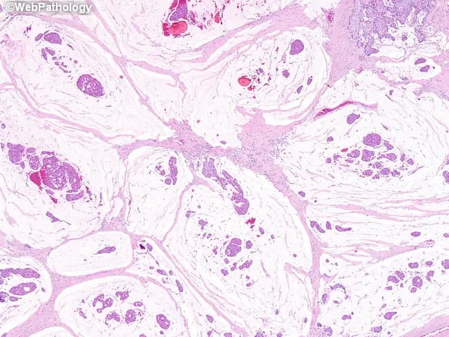 This histopathology image depicts a breast tissue section stained with Hematoxylin and Eosin (H&E) viewed under light microscopy. The primary subject is mucinous (colloid) carcinoma of the breast, an invasive carcinoma variant defined by abundant extracellular mucin. In the field, tumor cells form cohesive clusters floating within large mucin pools; the pools are partially separated by delicate fibrous septa, producing lakes-with-septa architecture. The neoplasm demonstrates multiple architectural patterns, including solid nests, cribriform cords, and trabecular strands embedded in a mucinous matrix. Cellular morphology shows cohesive epithelial cells with round to oval nuclei and vesicular chromatin; mitotic activity is typically low in classical mucinous carcinoma. The mucin-rich stroma imparts a pale, basophilic background with mucin lakes that may appear vacuolated. Invasion into surrounding fibrous stroma may be subtle but detectable at the tumor-stroma interface. Overall, the image highlights the hallmark features: extracellular mucin pools, partial fibrous septation, and tumor proliferation in cribriform, solid, and trabecular patterns, consistent with mucinous breast carcinoma. Clinically, these histology features correlate with a relatively favorable prognosis compared with non-mucinous invasive ductal carcinoma and assist in differential diagnosis from mucin-producing carcinomas of other primaries. This representation is educational for pathology practice, diagnosis, and training. For medical learners.