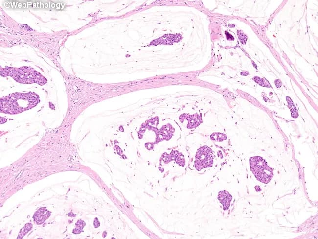 Histopathology, light microscopy of a breast tissue specimen stained with Hematoxylin and Eosin (H&E). The primary subject is an invasive mucinous (colloid) carcinoma of the breast. Diagnostic hallmarks are clusters of tumor cells embedded in abundant extracellular mucin pools, with mucin partially compartmentalized by delicate fibrous septa. Tumor cells arrange in solid, cribriform, and trabecular patterns within the mucin lakes, reflecting glandular differentiation in a myxoid background. The cells typically display round to oval nuclei with moderate cytoplasm, mild pleomorphism, and conspicuous nucleoli variably present; mitotic activity is often low to moderate. Surrounding stroma is fibrous and may show hyalinization; mucin pools appear as pale eosinophilic material separating clusters. These features help distinguish mucinous carcinoma from classic invasive ductal carcinoma and from mucin-producing metastases. Clinically, this histology portends a comparatively favorable prognosis relative to nonmucinous invasive breast cancers, especially when tumor size is limited and nodal involvement is absent. In diagnostic practice, recognizing extracellular mucin with cohesive tumor clusters aids classification, informs surgical planning, and guides adjuvant therapy decisions. Differential considerations include invasive ductal carcinoma with mucinous differentiation and metastatic mucin-secreting tumors. The image provides essential cues for pathology reports, education, and research on mucin biology in breast cancer.