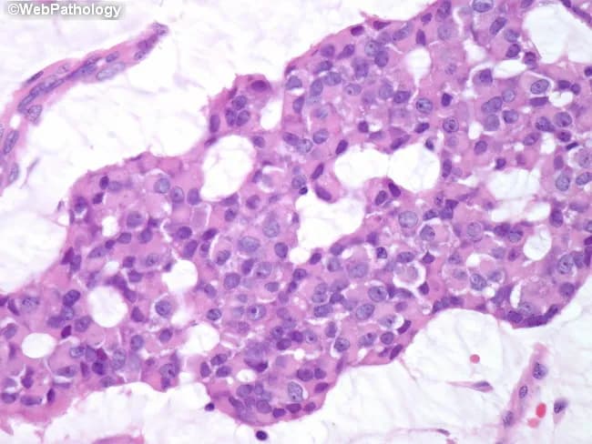 High-magnification bright-field histology image of breast parenchyma showing invasive mucinous (colloid) carcinoma with a mixture of solid and cribriform growth patterns. The tumor displays abundant extracellular mucin pools that create lakes in which clusters and occasional cords of neoplastic cells are dispersed. The neoplastic cells are relatively uniform, with small to medium-sized nuclei, round to oval contours, few conspicuous nucleoli, and minimal pleomorphism, consistent with well-differentiated histology. Mitotic activity is low and necrosis is not evident. Cribriform nests intersect the mucinous stroma, while solid foci demonstrate cohesive tumor islands embedded in mucinous matrix. In the surrounding breast parenchyma, fibrous stroma and adipose tissue may be present with mild stromal reaction but no extensive desmoplasia. The overall pattern aligns with mucin-producing adenocarcinoma of the breast, colloid type, which generally carries a favorable prognosis relative to conventional ductal carcinoma. Clinically relevant features include ER/PR positivity in many cases and a relatively indolent course; radiologic correlation may show a well-circumscribed, mucin-rich mass mimicking benign lesions. This image is valuable for pathology education, differential diagnosis with other mucinous and ductal carcinomas, and training in recognizing low-grade mucinous patterns at high magnification. Overall, this image captures characteristic mucin pools and uniform cellularity.