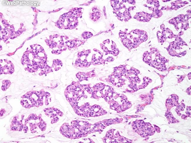 Light microscopy of hematoxylin and eosin stained breast tissue demonstrates a pure mucinous (colloid) carcinoma pattern with abundant extracellular mucin lakes. Tumor cells are arranged in small cohesive clusters and islands that float within pools of mucin, often showing low-grade cytology with round to oval nuclei and minimal pleomorphism. Mitotic figures are infrequent, and desmoplastic stromal reaction is limited, yielding a relatively well-circumscribed rather than aggressively infiltrative appearance. The mucin-rich matrix dominates the histologic landscape, with occasional signet-ring-like cells present but not prominent. Such histology produces a characteristic translucent, gelatinous background on gross examination and a distinctive cellular screed on microscopic slides. Immunophenotype commonly includes estrogen receptor (ER) and progesterone receptor (PR) positivity, with HER2 amplification typically absent, consistent with favorable prognosis. The abundant mucin is thought to hinder vascular invasion and lymphovascular spread, contributing to the excellent prognosis described for pure mucinous breast carcinomas. Clinically, this histology correlates with lower nodal metastasis rates and favorable survival, influencing surgical management and adjuvant therapy decisions. Differential diagnoses include mucinous carcinoma with an invasive ductal component and, less likely, signet-ring cell carcinoma; correlate with imaging, receptor status, and clinical course for definitive classification and treatment planning. This image exemplifies mucinous breast carcinoma.