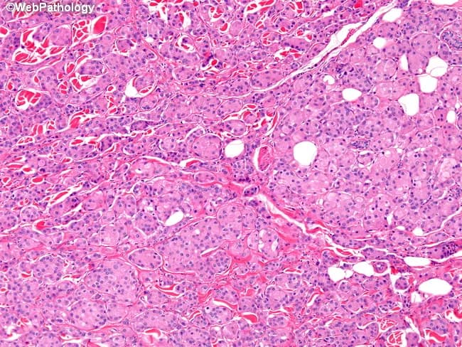 This image depicts a hematoxylin and eosin (H&E) stained histology slide of invasive apocrine carcinoma within breast parenchyma. Imaged with bright-field light microscopy at moderate magnification, the tissue shows nests and irregular cords of polygonal tumor cells infiltrating a dense, collagenous stroma. Cells characteristically possess abundant eosinophilic cytoplasm and apocrine-type features; nuclei are variably high in grade overall, though this exemplar demonstrates low-to-intermediate nuclear grade with occasional prominent nucleoli. The tumor nests are surrounded by desmoplastic stroma, and a chronic lymphocytic infiltrate is often present in the adjacent stroma. GCDFP-15 immunoreactivity is a supportive marker for apocrine differentiation, though it is not required to establish the morphologic diagnosis. The typical receptor profile includes estrogen receptor (ER) and progesterone receptor (PR) negativity with androgen receptor (AR) positivity; HER2 expression is negative in about half of pure apocrine carcinomas. Clinically, recognizing apocrine morphology and AR positivity can influence therapeutic considerations, including potential anti-androgen strategies, even when ER/PR are absent. Immunohistochemical workup is essential to distinguish from ductal carcinomas with apocrine features or metaplastic variants. This image exemplifies the morphological hallmarks and immunophenotype relevant to diagnosis, prognosis, and targeted treatment planning in breast oncology.
