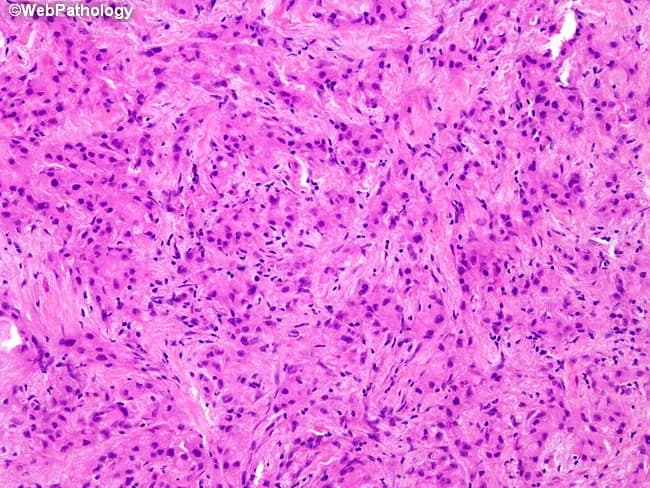 Histology by light microscopy of a breast tissue biopsy stained with Hematoxylin and Eosin (H&E). The specimen demonstrates invasive cells embedded in a dense desmoplastic stroma within the breast parenchyma. The primary neoplasm is described as invasive apocrine carcinoma, histiocytoid variant, characterized by plump epithelioid cells with abundant eosinophilic granular cytoplasm and prominent nucleoli, arranged in irregular cords and confluent nests. A differential diagnostic consideration is granular cell tumor, which can display similar eosinophilic granular cytoplasm but differs in cytologic detail and immunophenotype. In granular cell tumor, nuclei are small and hyperchromatic with minimal atypia, and tumor cells are strongly positive for CD68 and S-100, while negative for cytokeratin AE1/3. In contrast, apocrine carcinoma shows marked cytologic atypia, nuclear pleomorphism, and prominent nucleoli; immunophenotype typically demonstrates positivity for cytokeratin AE1/3 and is negative for CD68, with S-100 occasionally weakly positive. The biological significance lies in accurate classification, which guides prognosis and treatment. Clinically relevant implications include differential diagnosis between breast carcinoma with apocrine differentiation and granular cell lesion, interpretation in the context of receptor status, and implications for surgical management. An IHC panel including AE1/3, CD68, and S-100 is recommended to confirm lineage and differentiation, avoiding misdiagnosis and guiding therapy.