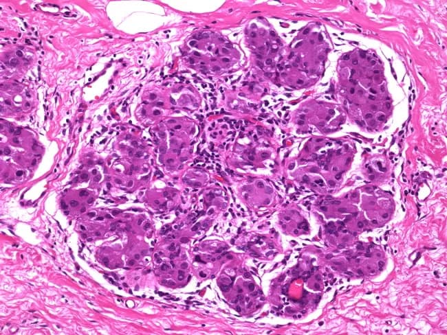This is a histopathology micrograph of breast tissue stained with Hematoxylin and Eosin (H&E) at high magnification, illustrating apocrine-type ductal carcinoma in situ (DCIS) with extension into lobular structures. The image highlights solid and cribiform ductal proliferations composed of large polygonal cells with abundant eosinophilic, granular cytoplasm, prominent nuclei, and conspicuous nucleoli, consistent with apocrine differentiation. These neoplastic apocrine cells are arranged within ductular and lobulocentric spaces, and are embedded in fibrous stroma with focal sclerosing adenosis, raising potential mimics of invasive carcinoma if the myoepithelial boundary is disrupted. The apocrine DCIS demonstrates an in-situ pattern without overt stromal invasion. In practice, E-cadherin immunostaining may be used to differentiate this entity from lobular neoplasia: apocrine DCIS typically preserves membranous E-cadherin expression, whereas lobular carcinoma in situ shows absent or fragmented staining. Myoepithelial markers (p63, smooth muscle actin, calponin) can aid in confirming an in-situ process by highlighting an intact/basal myoepithelial layer surrounding ducts and lobules. This image underscores the diagnostic challenge when apocrine DCIS extends into sclerosing adenosis and may simulate invasive carcinoma; careful histomorphology combined with ancillary immunohistochemistry is essential for accurate classification and subsequent clinical management. Ancillary testing and multidisciplinary review guide appropriate surgical and adjuvant therapy decisions.