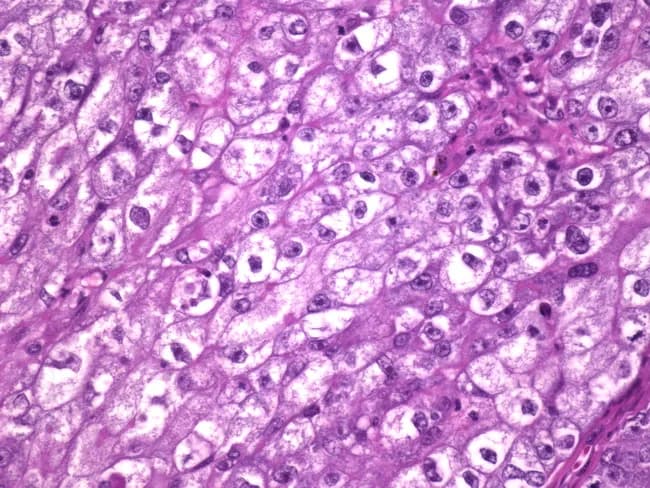 Imaging modality: Hematoxylin and eosin stained histology of breast tissue showing glycogen-rich clear cell carcinoma. The specimen is breast parenchyma with tumor cells arranged in solid sheets and nests; cells have abundant clear to amphophilic cytoplasm and vesicular nuclei with prominent nucleoli. Mitoses are rare, supporting a relatively indolent biology. The cytoplasmic clearing is consistent with glycogen-rich content; PAS staining would be positive and diastase-sensitive. The tumor often displays minimal gland formation and infiltrative growth into surrounding stroma; in this image, neoplastic cells replace normal ducts and lobular architecture. Clinically, such tumors tend to have an excellent prognosis despite a reported 30% axillary lymph node metastasis rate, and five-year survival approaches 100% with appropriate treatment, reflecting a relatively favorable outcome for breast carcinoma variants. Immunophenotype commonly includes hormone receptor positivity (ER/PR) and variable HER2 status, aiding differential diagnosis from metastatic clear cell renal cell carcinoma, which would be negative for breast lineage markers. The pathologic diagnosis highlights clear cell or glycogen-rich clear cell carcinoma of the breast, a rare entity with distinctive cytoplasmic appearance but favorable prognosis. This image is relevant for educational comparisons between histologic patterns of clear cell breast carcinomas and other clear cell neoplasms, and for references in diagnostic radiology-pathology correlation studies and clinical oncology.