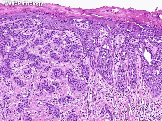 High-fidelity light microscopy of a breast tissue section stained with hematoxylin and eosin demonstrates the classic biphasic appearance of Paget disease of the nipple with an associated invasive ductal carcinoma. The right half of the field shows Paget cells—large, round to oval cells within the epidermis and epidermal appendages, with ample pale cytoplasm, large hyperchromatic nuclei, conspicuous nucleoli, and occasional mitotic figures arranged in a pagetoid pattern along the basal and suprabasal layers. Interspersed keratinocytes and a mild inflammatory infiltrate may be present; the epidermal surface lies atop underlying dermal stroma. The left half reveals an invasive ductal carcinoma component characterized by irregular glandular formations, nests of malignant epithelial cells, cytologic atypia, and a desmoplastic stromal reaction. Invasive tumor cells infiltrate the breast parenchyma beyond ducts, concordant with ductal pathology; mucinous or papillary variants are rare possibilities but not clearly proven in this specimen. The image highlights the strong association of Paget disease with underlying in-situ or invasive carcinoma, most commonly ductal type, with reported incidence around 82–94%. Clinically, this histology supports a diagnosis of PD with concurrent IDC, guiding surgical planning, lymph node assessment, and adjuvant therapy considerations. Diagnostic significance lies in confirming nipple-centric Paget spread with concurrent malignancy.