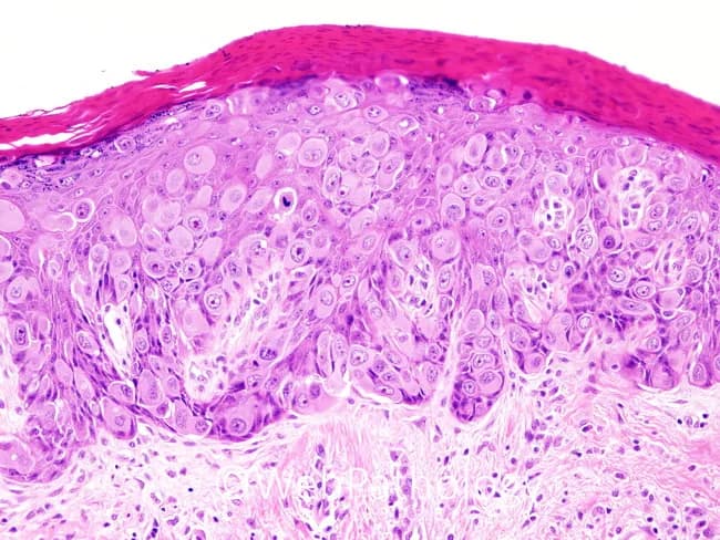 This histopathology image depicts classic mammary Paget disease involving nipple-areola skin. Prepared as a hematoxylin and eosin (H&E) stained paraffin section, the epidermis shows intraepidermal Paget cells with voluminous pale eosinophilic cytoplasm, large vesicular nuclei, and prominent nucleoli. These malignant glandular cells extend through the full thickness of the epidermis, exhibiting marked cytologic atypia and brisk mitotic activity. The Paget cells often form cohesive clusters within the epidermis and may infiltrate the entire epithelial layer, with occasional discohesive cells at the dermal–epidermal junction. Background dermis may display mild chronic inflammatory changes; adnexal structures can be variably preserved. This pattern is highly suggestive of mammary Paget disease and is typically associated with an underlying ductal carcinoma in situ or invasive breast carcinoma, although the underlying neoplasm may not be represented in a single slide. Clinically, nipple-areola erythema, scaling, and crusting prompt biopsy; histology confirming Paget cells establishes diagnosis and guides management. Differential considerations include extramammary Paget disease, melanoma in situ with pagetoid spread, and Bowen disease. The finding has critical diagnostic significance, informing surgical planning, staging workup, and adjuvant therapy decisions in breast cancer care, including sentinel lymph node assessment and radiotherapy decisions.