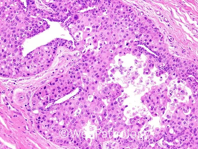 Bright-field light microscopy of a hematoxylin-eosin stained histologic section from the nipple-areolar complex of a human breast. The specimen demonstrates mammary Paget disease with extension of malignant glandular epithelial cells into the epidermis of the nipple and within lactiferous duct lumina. Paget cells are characterized by large, round to oval cells with abundant pale cytoplasm, enlarged hyperchromatic nuclei, and prominent nucleoli. These cells often line or disrupt the keratinizing epidermis and may form small clusters or single-cell infiltrates set against a desmoplastic stroma in adjacent dermis. In many cases, intraepithelial spread is accompanied by focal mucin production and occasional signet-ring-like cytoplasmic clearing, supporting an adenocarcinoma origin. The observed pattern suggests an underlying ductal carcinoma in situ or invasive carcinoma in continuity with the epidermal involvement, although the surface epithelium can sometimes appear non-specific in isolation. Clinically, this histology confirms mammary Paget disease and flags the likelihood of underlying breast carcinoma, mandating comprehensive imaging (mammography, ultrasound, MRI) and staged surgical management. This image is invaluable for dermatologic-pathologic correlation, breast-conserving therapy planning, educational demonstrations of Paget pathology, and differential considerations against nipple dermatitis or melanoma. Overall, the case exemplifies the classic Pagetoid spread of malignant cells from ducts to epidermis, with clinical implications for prognosis and treatment.