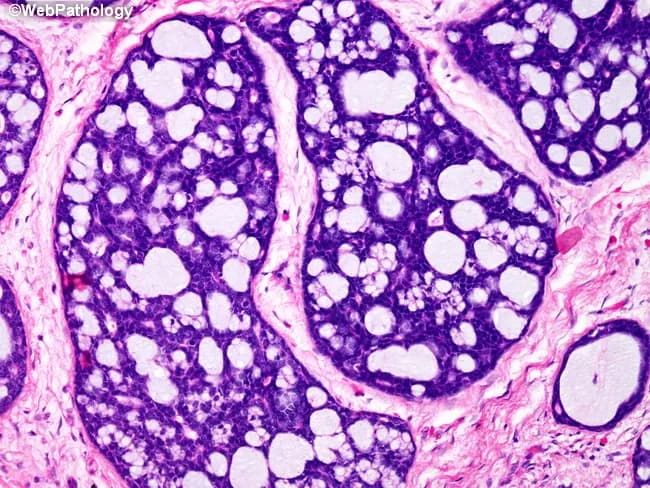 Adenoid cystic carcinoma of salivary gland on histology showing multiple nests with cribriform architecture, surrounded by a cuff of cellular myxoid stroma. Pseudoglandular lumina are filled with basophilic mucopolysaccharide-rich material that stains with Alcian blue, containing hyaluronic acid and sulfated acid mucins. The tumor cells are small, basaloid with uniform nuclei; perineural invasion may be present in some cases (not visible in this field). The pattern described—cribriform nests with mucoid, myxoid stroma—is classic for ACC and correlates with glandular origin from salivary tissue. Diagnostic significance lies in confirming ACC, guiding management toward surgical excision with wide margins and adjuvant radiotherapy, and anticipating potential perineural spread and recurrence. Differential considerations include mucoepidermoid carcinoma, basaloid adenocarcinoma, and polymorphous adenocarcinoma. Clinically, the image supports educational and diagnostic applications in head and neck pathology, pathology training, and research contexts. It is valuable for teaching histology of salivary gland neoplasms, pattern recognition of cribriform and myxoid components, and mucin staining interpretation. This image is valuable for diagnostic education, histopathology training, and multidisciplinary tumor boards.