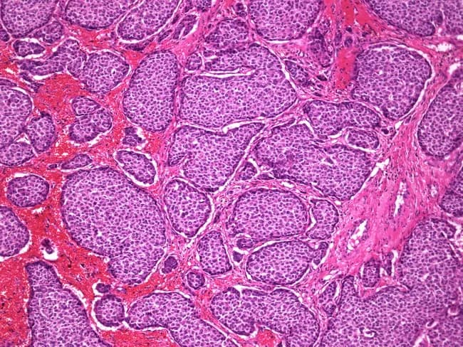 Imaging modality: Light microscopy of Hematoxylin and Eosin stained breast tissue sections. The section shows invasive carcinoma of the breast with neuroendocrine differentiation, characterized by small to large nests of tumor cells embedded in a fibrovascular stroma. Tumor cells are polygonal with uniform cytoplasm and round to oval nuclei; the nests are tightly packed and separated by thick pink (eosinophilic) septa, consistent with desmoplastic fibrous stroma. The overall architecture resembles ductal carcinoma of the breast, with features consistent with an invasive ductal carcinoma with neuroendocrine differentiation (carcinoid-like breast tumor). The histology may overlap with neuroendocrine tumors but in this context, the nest pattern within breast parenchyma supports a primary breast carcinoma rather than a metastatic neuroendocrine tumor. Immunohistochemical confirmation with neuroendocrine markers (synaptophysin, chromogranin) and hormone receptor status (estrogen receptor, progesterone receptor) would aid definitive classification and therapeutic planning. The diagnostic significance lies in recognizing neuroendocrine differentiation as a histologic variant of breast carcinoma, which can influence prognosis and treatment, and underscores the relationship between carcinoid-like breast tumors and conventional ductal carcinomas. Clinically relevant use cases include education on breast cancer histology, differential diagnosis of neuroendocrine breast tumors, and correlation with imaging and molecular profiling for targeted therapy.