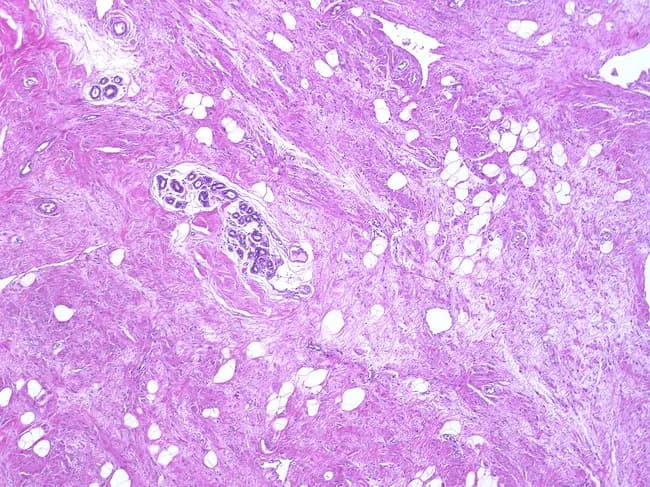 This case depicts a breast tissue histology slide prepared with Hematoxylin and Eosin stain, viewed at low to moderate magnification, illustrating a benign hamartomatous lesion (adenolipoma variant) within the mammary parenchyma. The lesion is well circumscribed, with a pseudocapsule created by compressed adjacent breast tissue. The mass consists of a heterogeneous admixture of mature adipose tissue intermingled with normal-appearing breast parenchyma, including ducts and lobules embedded in fibrous stroma. No cytologic atypia or mitotic activity is evident. The adipose component varies in proportion, reflecting the adenolipoma spectrum, while the epithelial elements form orderly acini and ducts surrounded by myoepithelial cells. The capsule-like margin and lack of invasion support a benign diagnosis. Clinically, hamartomas present as painless, movable breast nodules in premenopausal women but can occur across age groups. Radiologic imaging typically shows well-defined, round or oval masses with compressed breast tissue at the periphery. Pathological differential includes lipoma, fibroadenoma with lipomatous stroma, or other lipomatous or fibroepithelial lesions. Accurate histologic characterization is essential to distinguish from malignant neoplasms and to guide conservative surgical management when indicated. This description supports reproducible search terms for pathology education, breast disease registries, and radiology-pathology correlation studies to enhance case characterization and teaching.
