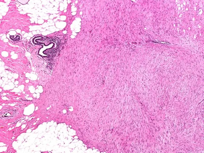 Breast tissue histology slide. Low-power observation reveals an ill-defined, infiltrative mass in mammary stroma with spindle cells arranged in sweeping fascicles and abundant dense collagen. The tumor abuts and extends into adjacent breast parenchyma and adipose tissue, producing stellate projections at the margins. Cellular morphology shows uniform, elongated spindle cells with slender elongated nuclei, minimal cytologic atypia, and low mitotic activity. The stroma is variably collagenized with scant vascularity. No overt epithelial malignancy is seen; ducts and lobules are entrapped by the desmoplastic, fibrous neoplasm. Immunohistochemistry (if performed) would favor a myofibroblastic phenotype with cytokeratin negativity and nuclear beta-catenin positivity supporting desmoid-type fibromatosis; smooth muscle actin (SMA) and vimentin positivity can be observed. The pattern can mimic carcinoma due to infiltrative growth and dense stroma, making correlation with clinical and radiologic findings essential. Clinically, fibromatosis of the breast presents as a firm, non-tender mass; radiographic appearance may mimic carcinoma; management requires wide local excision with negative margins to reduce recurrence. The lesion lacks metastatic potential but bears a notable risk of local recurrence. This image is educational for surgical pathology, spindle cell breast lesions, and radiologic-pathologic correlation in breast disease.