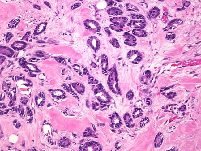 High-magnification hematoxylin and eosin stained histology image of male breast tissue showing invasive tubular carcinoma. The specimen reveals an infiltrating architecture composed of uniformly small, cuboidal to columnar epithelial cells forming well-differentiated, angulated tubular glands with open lumina embedded in desmoplastic fibrous stroma. The myoepithelial layer surrounding lumina is variably diminished, consistent with invasive ductal carcinoma with tubular differentiation. Nuclei are relatively small, round to oval with mild hyperchromasia and minimal pleomorphism; mitotic activity is infrequent. The stroma is pink, densely fibrous, with sparse inflammatory infiltrate. There is no marked necrosis or mucin lakes. The tubular glands demonstrate low-grade cytology and orderly tubular architecture characteristic of tubular carcinoma, a well-differentiated histologic variant of breast cancer. In male patients, this lesion is rare but generally portends a favorable prognosis compared with high-grade ductal carcinomas. The image highlights histopathologic hallmarks of tubulary differentiation and invasion, underscoring the diagnostic value of routine H&E staining in distinguishing tubular carcinoma from other invasive breast cancers such as conventional invasive ductal carcinoma or mucinous variants. Clinically, tubular carcinoma in men is frequently estrogen receptor positive with good response to hormonal therapy after definitive surgical management. Indeed.