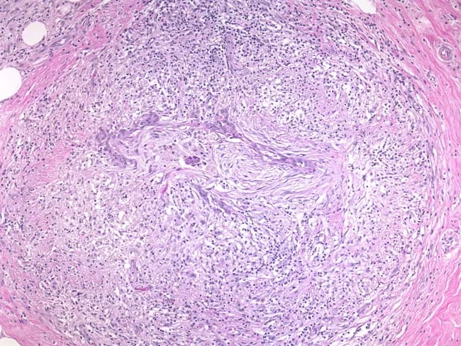 Breast tissue histology image obtained from hematoxylin and eosin stained section viewed under light microscopy of a granulomatous mastitis specimen. The specimen is from breast tissue showcasing destruction of native architecture with a cuff of inflammatory infiltrate surrounding residual distorted ducts, consistent with periductal granulomatous inflammation. The granulomas are typified by aggregates of epithelioid histiocytes, occasional Langhans-type giant cells, and a surrounding lymphoplasmacytic infiltrate. Ductal structures appear distorted or obliterated within a dense inflammatory milieu; there is little or no evident caseous necrosis in this field. This pattern can arise from various etiologies, including infectious agents such as Mycobacterium tuberculosis, non-tuberculous mycobacteria, fungi, brucella, or parasitic organisms, as well as idiopathic granulomatous mastitis or a granulomatous response adjacent to mammary carcinoma. Clinically, granulomatous mastitis may mimic breast carcinoma due to focal mass effect and architectural distortion, underscoring the importance of correlating morphology with microbiological studies and imaging. The diagnostic significance lies in distinguishing inflammatory/granulomatous breast disease from neoplasia, guiding appropriate testing (culture, PCR, fungal stains) and therapy (antimicrobials, corticosteroids, or surgical management). This image is relevant for educational purposes in pathology, surgical oncology, radiology, and breast disease research and serves as a reference for differential diagnosis in granulomatous breast lesions.