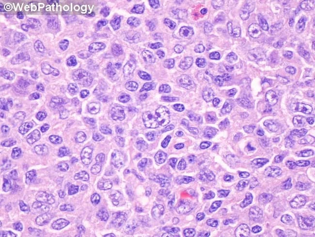 Imaging modality: Brightfield light microscopy of a hematoxylin-eosin (H&E) stained tonsillar biopsy section. Specimen: Tonsil (palatine), from a 17-year-old with clinically suspected infectious mononucleosis. Location: Waldeyer’s ring in the oropharynx; lymphoid tissue in the tonsillar crypts and interfollicular areas. Visual features: At center, a binucleated Reed-Sternberg-like cell with prominent eosinophilic nucleoli and ample cytoplasm; scattered similar giant cells among a polymorphous background of small to medium lymphocytes, occasional plasma cells, and histiocytes; overall architectural effacement of normal tonsillar nodularity. Immunophenotype context (inferred): RS-like cells in EBV-associated mononucleosis often co-express CD30 and CD20 with CD15 negativity; not demonstrated in this image. Pathological interpretation: Features are characteristic of EBV-associated infectious mononucleosis with RS-like cells rather than classical Hodgkin lymphoma; the CD15− phenotype helps distinguish from CD15+/CD30+ Hodgkin disease. Diagnostic significance: Recognition of CD30+/CD20+/CD15− RS-like cells in tonsillar tissue supports EBV-driven reactive process and guides appropriate clinical management toward supportive care and EBV monitoring. Clinical correlation: In adolescents with fever, pharyngitis, cervical adenopathy, and fatigue, EBV infection is likely; serology and peripheral blood smear should be correlated. Potential clinical use cases: Educational reference for tonsillar histology in EBV infection; differential diagnosis with Hodgkin lymphoma; pathology board review and atlas annotation.