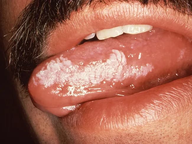 Hairy leukoplakia (HL) of the oral mucosa is a chronic EBV-driven epithelial lesion seen most commonly in severely immunosuppressed individuals, particularly people living with HIV/AIDS. It presents as a painless, pale white plaque on the tongue, usually along the lateral borders, with a shaggy, corrugated surface that cannot be scraped off. In early stages, one notes vertical keratin streaks or fissures oriented perpendicular to the tongue’s long axis. In advanced disease, the involvement can extend to the dorsal tongue, bilateral lateral surfaces, buccal mucosa, soft palate, pharynx, or even the esophagus. HL is considered an AIDS-defining opportunistic infection and serves as a clinical marker of severe immunosuppression; however, it does not confer increased risk for dysplasia or squamous cell carcinoma, unlike true leukoplakia. Clinically, HL must be differentiated from oral candidiasis, true leukoplakia, lichen planus, and other mucosal white plaques. The diagnosis is typically clinical but may be confirmed by EBV in situ hybridization or PCR if tissue is obtained; HIV management with antiretroviral therapy often leads to regression. This lesion carries educational significance for clinicians, dentists, and trainees, illustrating the spectrum of EBV-related oral disease in HIV, transplant recipients, and occasionally immunocompetent hosts. Recognition aids diagnosis and treatment planning.