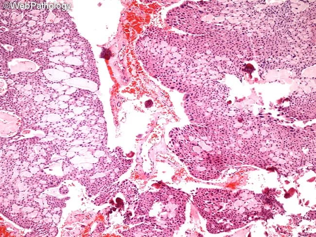 Calcifying epithelial odontogenic tumor (CEOT), also known as Pindborg tumor, is an odontogenic epithelial neoplasm typically arising in the jaw, most often the posterior mandible. This histopathology image depicts a micrograph of CEOT stained with hematoxylin and eosin. The tumor shows sheets, nests, and strands of polygonal epithelial cells embedded in a variably dense fibrous stroma. The cells possess abundant eosinophilic cytoplasm, distinct cell borders, and prominent intercellular bridges. Nuclear pleomorphism may be present in some fields, including giant nuclei, but mitotic activity remains low and is not indicative of malignancy. A hallmark feature is the extensive eosinophilic amyloid-like extracellular material that often fills the stromal spaces and may juxtapose calcified deposits. Calcifications develop in association with this amyloid, frequently forming concentric Liesegang rings. In some cases, epithelial component predominates with little amyloid or calcification; in others, sparse nests are separated by large amyloid-rich areas. Rarely, a clear cell variant with cystic growth has been described. The combination of epithelial cells, amyloid-like material, and characteristic calcifications is diagnostically distinctive and helps differentiate CEOT from ameloblastoma, calcifying odontogenic cyst, and other odontogenic tumors. Clinically, CEOT is generally benign but locally aggressive, requiring complete surgical excision, with potential for recurrence if incomplete.