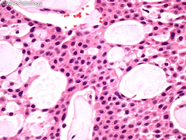 This 400x hematoxylin and eosin-stained histology image depicts a calcifying epithelial odontogenic tumor (CEOT), also known as Pindborg tumor, derived from odontogenic epithelium in the jaw. The tissue demonstrates cohesive sheets and nests of polygonal epithelial cells with abundant eosinophilic cytoplasm, distinct cell borders, and prominent intercellular bridges, most evident in the central portions. Nuclei are generally round to oval with mild pleomorphism and low mitotic activity. The tumor matrix is variably dense with scattered, round to oval extracellular deposits that resemble amyloid and are characteristic of CEOT. These amyloid-like deposits frequently calcify, forming irregular concentric rings or Liesegang-type calcifications that appear as basophilic or eosinophilic speckles disrupting the stroma and sometimes outlining cell clusters. The surrounding stroma is somewhat vascular and may contain dystrophic calcifications. Overall, the image shows a benign yet locally infiltrative neoplasm composed of epithelial cells in close association with mineralized material, with intact basal membrane in many areas. Diagnostic significance rests on the combination of epithelial sheets, amyloid-like material, and calcifications, a pattern that differentiates CEOT from other odontogenic tumors such as ameloblastoma. Clinically relevant features include potential jaw swelling and radiographic radiolucent lesions with calcifications, guiding surgical planning and prognosis. These features aid diagnosis and management.
