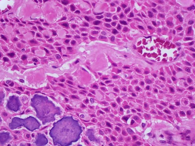 Imaging modality: Brightfield light microscopy of a hematoxylin and eosin stained histology section of jaw odontogenic tumor tissue. The specimen demonstrates classic calcifying epithelial odontogenic tumor (CEOT), also known as Pindborg tumor, arising in a tooth-bearing region of the mandible. Sheets, nests, and occasional strands of polygonal epithelial cells exhibit abundant eosinophilic cytoplasm with distinct cell borders and prominent intercellular bridges. The tumor nests are embedded in a fibrous stroma that ranges from moderately to densely collagenous. A characteristic feature is the presence of large extracellular amyloid-like material, sometimes forming concentric calcifications known as Liesegang rings. Calcifications are variably birefringent under polarized light and appear as rounded, ring-like deposits within the amyloid. The nuclei are generally small to moderately pleomorphic with mild mitotic activity, consistent with a benign yet locally invasive odontogenic neoplasm. Collectively, the combination of epithelial polygons, amyloid-like deposition, Liesegang rings, and calcifications strongly supports CEOT and helps distinguish it from ameloblastoma and other odontogenic lesions. Clinically, CEOT tends to present as a slow-growing jaw mass in adults; management is surgical excision with careful follow-up for recurrence. This image is valuable for educational purposes, differential diagnosis, and pathology reference. Correlation with radiographs and clinical behavior improves diagnostic confidence.
