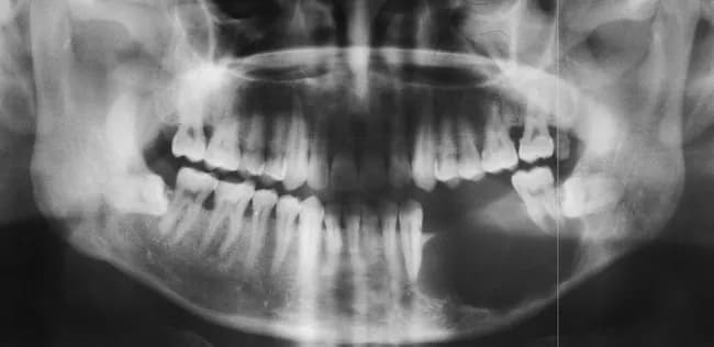 This is a two-dimensional panoramic dental radiograph (Orthopantomogram) of the mandible displaying a large, radiolucent lesion in the left hemi-mandible. The lesion is expansile and predominantly multilocular, with classic soap-bubble (when locules are large) or honeycomb (when locules are small) appearance described for ameloblastoma on plain films. The borders are well-demarcated and scalloped, and there is no radiopaque matrix or calcification within the lesion. Cortical expansion is evident with cortical breach and thinning; the lesion displaces and resorbs adjacent teeth, producing tooth mobility and in this image a floating or absent left second molar region. An associated unerupted or impacted third molar is frequently observed with ameloblastoma and may be present here, contributing to crowding and dentition loss. The radiographic differential includes odontogenic cysts and tumors; however, the combination of a large multilocular radiolucency with cortical perforation and tooth displacement strongly favors ameloblastoma. Clinically significant due to local aggressiveness and potential for recurrence, these lesions typically require surgical planning with margin resection. This image is illustrative for educational radiology, maxillofacial pathology, and dental tumor management, aiding recognition of mandibular ameloblastoma patterns, differential diagnoses, and treatment implications. Correlate with clinical findings and consider biopsy for definitive histopathology confirmation and management planning.