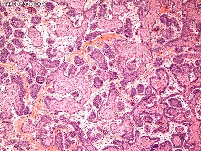 Histology: Light microscopy of a jaw lesion shows classic ameloblastoma morphology on hematoxylin and eosin stained tissue. The neoplasm is composed of multiple epithelial islands and cords embedded in a fibrous connective tissue stroma. Follicular pattern predominates, with nests of odontogenic epithelium displaying peripheral palisading of columnar cells and reversal of polarity, nuclei oriented away from the basement membrane. Central cells resemble stellate reticulum with loosely arranged, angular morphology. Some islands exhibit a loosely arranged, anastomosing arrangement compatible with plexiform architecture. Overall cellularity is moderate, with minimal pleomorphism and no overt mitotic activity in the field, consistent with benign but locally aggressive behavior. Basal layer cells are darkly basophilic with prominent nucleoli, while surrounding stroma is densely fibrous and occasionally myxoid, producing a subtle desmoplastic impression in portions of the section. The tumor borders appear infiltrative into adjacent connective tissue, reflecting its known propensity for local invasion despite benign cytology. There is an absence of keratinization, dysplasia, or metastatic features. The image highlights the diagnostic hallmarks: enamel organ–like islands, reverse polarity, stellate reticulum–like center, and a fibrous stroma. These histologic features underline confirmation of diagnosis and guide surgical planning in odontogenic tumors and jaw neoplasms. For educational and diagnostic purposes.