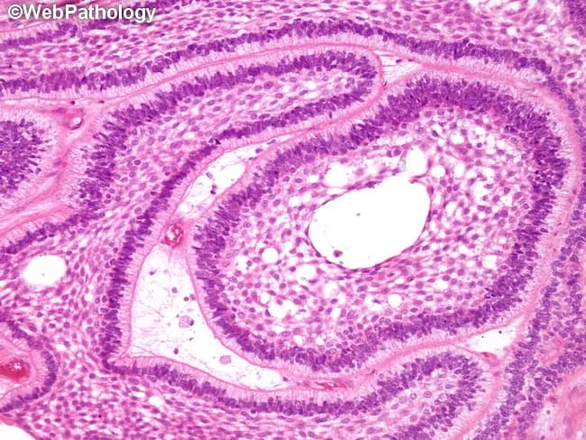 Imaging modality: Light microscopy of hematoxylin and eosin stained paraffin sections of an odontogenic jaw tumor. Anatomical localization: mandible or maxilla, commonly the posterior mandible; histologic plane is a transverse section through dental lamina–like islands within dense fibrous stroma. In this specimen, classic follicular ameloblastoma pattern dominates, with round to ovoid nests of odontogenic epithelium exhibiting peripheral palisading of columnar cells and reverse nuclear polarity away from the basement membrane. The peripheral layer rests on a basement membrane and displays elongated, polarized nuclei; centrally, loosely arranged polygonal to stellate reticulum–like cells form loosely cohesive islands. The islands are separated by mature fibrous connective tissue stroma, without marked keratinization. The overall architecture mimics the enamel organ of developing tooth, hence the term follicular. Additional patterns such as plexiform growth may be present in other areas, but not evident here. Clinically, ameloblastomas are benign but locally aggressive, with potential for local invasion and recurrence if incompletely excised. The image provides diagnostic evidence for odontogenic tumor identification, distinguishing from cystic lesions and other jaw tumors. Relevant differential diagnoses include plexiform ameloblastoma, acanthomatous type, and odontogenic keratocyst. This histology supports surgical planning, prognosis assessment, and educational discussion of jaw tumor pathology.