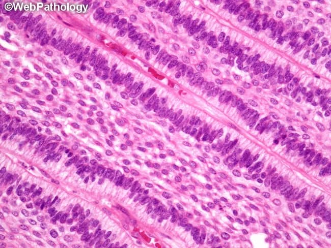 This histology image depicts ameloblastoma of the jaw, captured on a hematoxylin and eosin–stained biopsy section examined under light microscopy. The dominant pattern shown is follicular ameloblastoma, with oval to rounded islands of odontogenic epithelium embedded in a dense fibrous stroma. Peripheral columnar cells exhibit classic reverse polarity and peripheral palisading, while the central cells resemble the stellate reticulum of the developing tooth germ. In some regions, the epithelial nests are triangular or elongated and dispersed, consistent with alternate patterns that may coexist in the same tumor, including plexiform, acanthomatous, basaloid, granular cell, or desmoplastic variants. The nests are separated by a mature, hyalinized connective tissue stroma without prominent inflammatory infiltrate. The myxoid or hyalinized stroma and highly organized epithelial architecture help distinguish ameloblastoma from other odontogenic lesions. Clinically, these histologic features correlate with locally aggressive behavior despite benign cytology, underscoring the need for complete surgical excision with clean margins to minimize recurrence risk. The image emphasizes the diagnostically relevant hallmarks—pigmented? No, not pigmented; but rather cohesive islands with peripheral palisading and stellate reticulum core. This slide serves educational value for surgical planning, differential diagnosis, and radiologic-pathologic correlation in jaw lesions. It is suitable for teaching, research, and case documentation.