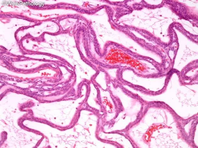 This histopathology slide, stained with Hematoxylin and Eosin and viewed under brightfield light microscopy at low to mid magnification, demonstrates classic plexiform ameloblastoma architecture within the jaw. Neoplastic odontogenic epithelium forms interconnected cords and anastomosing strands embedded in a loose, highly vascular stroma of fibrous connective tissue. The epithelial cords are composed of basaloid cells with peripheral cells often lacking the typical palisading and reverse nuclear polarity; within the cords, cells are more loosely arranged, resembling an inner stellate reticulum. Cystic change is uncommon in this plexiform subtype. The overall pattern shows benign cytology but a propensity for local invasion and bone destruction clinically. These features support the diagnosis of ameloblastoma, plexiform type, and help distinguish it from other odontogenic tumors and jaw cysts. Diagnostic significance includes confirming a locally aggressive, benign neoplasm that necessitates wide surgical excision with clear margins to minimize recurrence. Clinically, this pattern correlates with gradual cortical expansion and radiographic lytic lesions in the mandible or maxilla. In educational settings, the image is valuable for teaching odontogenic histology, subtyping ameloblastoma, and illustrating variations among follicular, plexiform, and desmoplastic patterns. Correlation with radiographs (multilocular radiolucencies) and clinical jaw swelling reinforces a multidisciplinary management approach.
