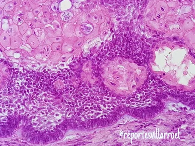 Imaging modality and technique: Light microscopy of hematoxylin and eosin (H&E) stained paraffin-embedded jaw lesion tissue, sectioned for routine histology. Anatomical localization: odontogenic tumor of the mandible, with epithelial islands embedded in a dense fibrous stroma consistent with ameloblastoma. The image demonstrates the acanthomatous variant, in which extensive squamous metaplasia occurs within the central portion of the epithelial islands, accompanied by keratin formation in the stellate reticulum. Peripheral ameloblast‑like cells show palisaded, polarized basilar nuclei; the central cells resemble the loosely arranged, eosinophilic stellate reticulum. The surrounding stroma is dense and vascular, with inflammatory cells in some fields. Notable architectural diversity is evident: nests and cords display follicular and plexiform arrangements, with focal desmoplastic areas and possible granular cell change in other regions. Such histology reflects intricate tumor biology while retaining characteristic features of ameloblastoma. Diagnostic relevance centers on distinguishing this entity from squamous odontogenic tumor and squamous cell carcinoma, as management and prognosis differ markedly. Key differentiators include peripheral palisading and reverse polarity, central stellate reticulum with metaplasia, and lack of overt malignant cytology. Clinically, recognizing acanthomatous ameloblastoma guides surgical planning and follow-up in jaw pathology and head‑neck oncology. This image serves as a reference for education and research.