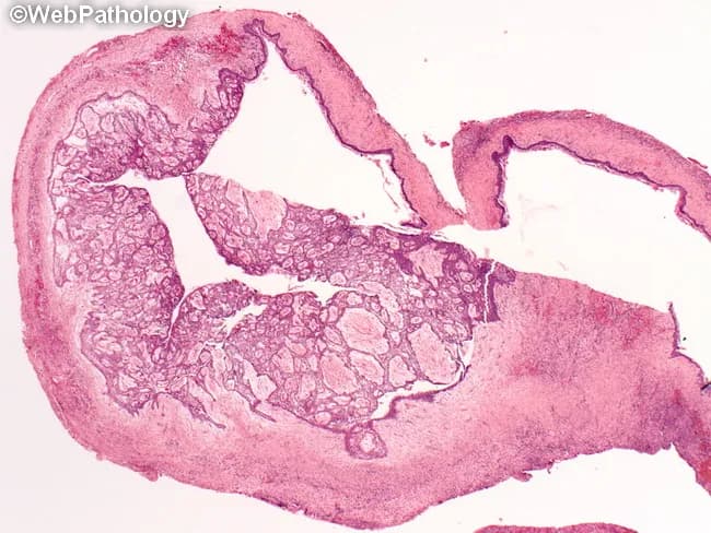 Histology: Light microscopy; Hematoxylin and Eosin (H&E) stained section of a unicystic ameloblastoma arising in the mandible. The specimen is a cystic lesion, typically associated with an unerupted third molar, showing a well circumscribed cavity lined by ameloblastomatous epithelium. The lining displays basal palisading of columnar cells with reversed nuclear polarity and an overlying zone resembling stellate reticulum. In many fields there are intraluminal or mural tumor nests within the cyst wall, representing the proliferative component. The surrounding stroma is usually fibrous and vascular, sometimes with mild inflammation. Clinically and radiographically, the lesion can mimic a dentigerous cyst, primordial cyst, radicular cyst, or residual cyst; histopathology confirms ameloblastic differentiation and classifies it as unicystic variant. Pathologic diagnosis has prognostic significance because involvement limited to the cyst lining (luminal or simple unicystic) has a favorable prognosis with conservative enucleation, while invasion of the cyst wall (mural unicystic) or solid nodules increases recurrence risk and may require more aggressive resection. Potential clinical uses include surgical planning, radiologic-pathologic correlation, and educational differentiation of odontogenic cystic lesions. This image exemplifies the diagnostic interface between histology and radiology in juvenile jaw lesions and odontogenic tumors.