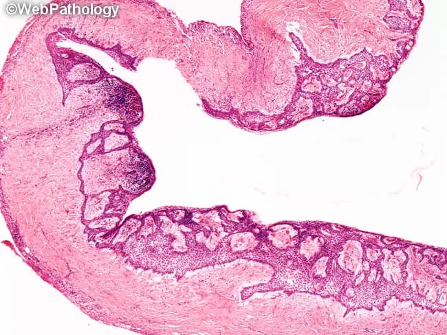 Histopathology slide of a jaw-based unicystic ameloblastoma, luminal subtype. Modality: light microscopy on hematoxylin and eosin-stained tissue, displaying a simple unilocular cyst with a fibrous wall. The cyst lining comprises ameloblastic epithelium with a tall columnar or cuboidal basal cell layer showing reverse nuclear polarity and peripheral palisading. The superficial cells toward the lumen resemble loosely cohesive stellate reticulum-like cells. The epithelium demonstrates luminal confinement, with no clear invasion into the cyst wall in this field. Intraluminal nodules or mural islands may be seen in other variants, but this specimen emphasizes luminal growth. Surrounding stroma is generally desmoplastic and collagenous without frank invasion by island in this view. Alternative terminology includes “odontogenic tumor” and “ameloblastoma variant” for educational clarity. Diagnostic significance: pattern supports a unicystic, luminal configuration with relatively favorable prognosis compared with multicystic forms, though recurrence risk persists if mural or intraluminal components are present. Relevant differential diagnoses include dentigerous cyst, inflammatory odontogenic cyst, and conventional solid/multicystic ameloblastoma. Clinically, histopathology guides surgical planning (enucleation vs resection) and informs prognosis; this image is valuable for oral pathology education, radiology-pathology correlation, and case-based learning in maxillofacial tumor pathology. This content supports learners in recognizing histologic patterns and correlating with radiographs globally.