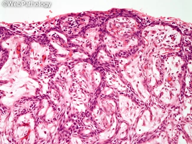 Modality: Brightfield light microscopy of hematoxylin and eosin stained histologic section from a jaw lesion. Specimen: cyst wall/tissue obtained from a presumed unicystic ameloblastoma of the mandible. Location: odontogenic tumor arising in the jaw; microscopic segment shows cystic architecture lined by ameloblastoma‑type epithelium with islands of tumor cells embedded in a fibrous stroma. The epithelial lining exhibits basal palisading of columnar cells with reverse polarity and a loosely formed stellate reticulum‑like center; in the mural variant, tumor islands infiltrate the fibrous cyst wall. The surrounding stroma is densely collagenous with scant inflammation; keratinization is minimal. The slide demonstrates classic features that overlap with odontogenic cysts but, in focal areas, demonstrates proliferating ameloblastomatous nests consistent with unicystic ameloblastoma. Clinically, unicystic ameloblastoma is often misdiagnosed as a dentigerous cyst; definitive diagnosis requires microscopic sampling and histopathologic subtyping into luminal, intraluminal, or mural variants. Prognosis and treatment depend on subtype; luminal and intraluminal lesions are typically managed by enucleation with close follow‑up, whereas mural invasion warrants more extensive resection due to higher recurrence (reported 10–20%, greatest risk with mural type). Long-term surveillance is essential given the potential for late recurrences and the need for radiographic monitoring.