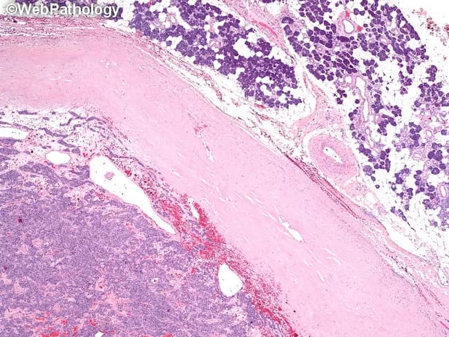Pleomorphic adenoma of a major salivary gland (parotid) is depicted on hematoxylin and eosin stained histology. The lesion is a well circumscribed, encapsulated neoplasm: a thick fibrous capsule delineates tumor from adjacent normal parotid tissue seen in the upper right, with the mass projecting toward the lower left. The tumor shows biphasic histology with epithelial elements forming duct-like structures and nests, embedded in a variably myxoid to chondromyxoid stroma. Epithelial cells range from cuboidal to columnar, often arranged in sheets and tubules, while myoepithelial cells display plasmacytoid to spindle morphologies, contributing to a heterogeneous, hyalinized background. The stroma may contain cartilaginous or osseous-like foci in places; overall architecture remains orderly rather than infiltrative. Capsule integrity is a key diagnostic cue; the capsule here is thick and typically prevents invasion, although small capsular breaches may explain rare recurrences if not completely excised. No significant necrosis or high mitotic activity is observed. Clinically, this benign mixed tumor presents as a slow-growing, painless parotid mass with preserved facial nerve function. Differential diagnoses include basal cell adenoma and Warthin tumor; mucoepidermoid carcinoma must be considered when ductal differentiation or invasion is suspected. The image highlights the classic pleomorphic adenoma biology: myxoid/chondroid stroma with epithelial/myoepithelial components within a robust capsule.