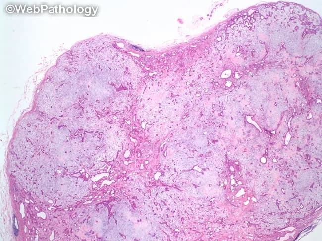 Pleomorphic adenoma (PA) of salivary gland, most commonly the parotid. This low-power histopathology image shows a well-demarcated, lobulated neoplasm with a bland appearance. The tumor is composed of a mixed epithelial and myoepithelial element embedded in a prominent myxoid-to-chondroid stromal background. Epithelial components form variable tubular and acinar structures, sometimes lining duct-like lumina, while myoepithelial cells contribute spindle, plasmacytoid, or clear cytoplasm elements; myxoid stroma gradually transitions to chondroid cartilage-like matrix. The capsule is usually incomplete or thin, allowing some intermingling with adjacent salivary tissue, but the lesion remains well circumscribed in this low magnification field. The histologic pattern is highly pleomorphic, depending on the relative proportion of ductal epithelium, myoepithelial cells, and stroma. Notable features include representation of both epithelial tubules and an abundant myxochondroid stroma, which helps distinguish PA from other salivary gland neoplasms. Clinically, PA is benign, slow-growing, and typically presents as a painless mass; malignant conversion is rare but possible. Immunohistochemistry may reveal cytokeratin-positive epithelial cells and S-100/GFAP-positive myoepithelial components. Treatment is surgical excision with adequate margins. The image exemplifies classic PA morphology: encapsulated lobules, biphasic cell populations, and a chondromyxoid extracellular matrix. The image provides a classic teaching example for salivary gland pathology and differential diagnosis.