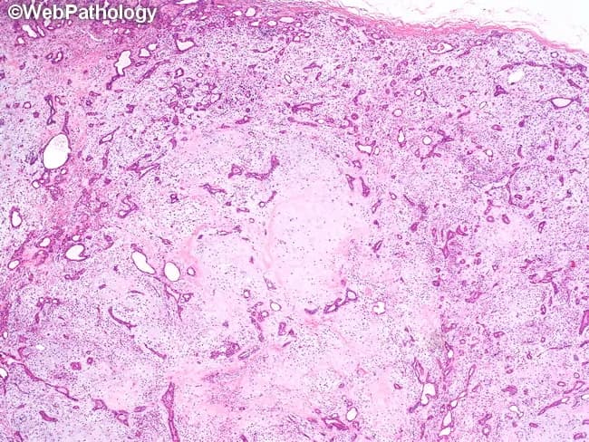 Imaging modality: light microscopy of a hematoxylin and eosin stained salivary gland specimen. This low-power view demonstrates a well-demarcated, lobulated pleomorphic adenoma arising in salivary gland tissue, most consistent with parotid origin. The tumor exhibits a biphasic epithelial/myoepithelial composition with duct-like tubular and acinar structures formed by epithelial cells admixed with variably sized myoepithelial cells. The stroma is abundant and myxoid to chondroid, producing a characteristic, amorphous, basophilic to pink background that supports chondromyxoid differentiation. The lobulated architecture suggests a pseudocapsule and circumscribed growth, while the epithelial elements display ductal differentiation and variable cellularity. Myoepithelial cells may appear spindle- to plasmacytoid-shaped, contributing to a spectrum of morphological patterns within a single lesion. Notable features include prominent stromal components (myxoid matrix, sometimes chondroid-like) alongside epithelial tubules; this histology underlies the classic description of pleomorphic adenoma as a mixed tumor. Clinically, this pattern correlates with a slow-growing, painless parotid mass, favorable prognosis with complete excision, and a need to avoid capsule rupture during surgery to minimize recurrence. Differential considerations include adenoid cystic carcinoma and mucoepidermoid carcinoma, which carry different clinical implications and require distinct management strategies. Overall, the image captures the quintessential PA histomorphology used for diagnostic confirmation and educational reference. Purposes.