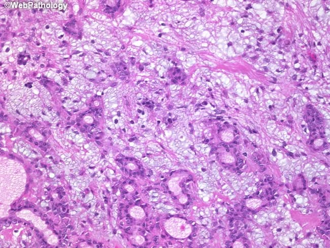 Imaging modality: light microscopy of hematoxylin and eosin stained salivary gland tissue section. The image captures the classic pleomorphic adenoma, a benign mixed tumor, showing a well circumscribed, lobulated neoplasm with a triphasic cellular composition. Epithelial ductal elements form cords and nests of cuboidal to columnar cells, while myoepithelial cells assume plasmacytoid or spindle morphologies surrounding the epithelial structures. The stroma is prominent and variably myxoid to chondromyxoid, creating a cartilaginous or hyaline backdrop. The overall pattern displays heterogeneity yet maintains benign cytology, with uniform nuclei, gentle chromatin, and minimal mitotic activity. No significant pleomorphism or invasion is evident. This combination of epithelial, myoepithelial, and stromal components underlies the tumor’s designation as a pleomorphic (mixed) adenoma. The image aligns with the molecular profile frequently observed: PLAG1 (8q12) and HMGA2 (12q13-15) rearrangements, while TP53 alterations are uncommon. Clinically relevant, pleomorphic adenomas most often arise in the parotid gland and present as slow-growing, painless masses. The diagnosis informs surgical management—complete excision with a margin to prevent recurrence—and highlights a potential, albeit rare, risk of malignant transformation to carcinoma ex pleomorphic adenoma in long-standing cases.