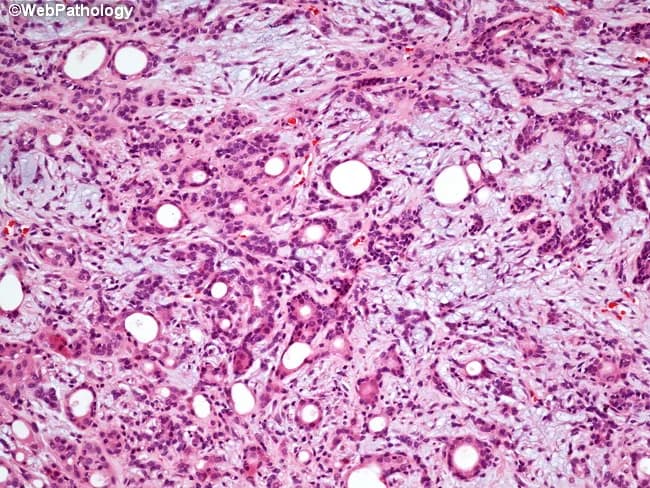 Histopathology of a pleomorphic adenoma from the superficial lobe of the parotid gland. This hematoxylin and eosin stained section demonstrates a benign mixed tumor with triphasic composition: an epithelial component forming cords and duct-like structures, a prominent myoepithelial component with plasmacytoid and spindle cells, and a variably myxoid to chondroid stromal background. The epithelial nests are embedded in a scant to abundant extracellular matrix that ranges from mucoid to cartilaginous, producing the characteristic pleomorphic, or pleomorphic, appearance. The tumor is usually encapsulated or pseudocapsulated with a fibrous capsule; widespread cellular atypia is absent; mitotic activity is rare. The interface with surrounding salivary tissue is well circumscribed, and small satellite nodules may be present at the periphery, accounting for recurrences if the capsule is breached during excision. Clinically, pleomorphic adenoma is the most common benign salivary gland tumor, typically presenting as a slow-growing, painless parotid mass in adults. Surgical management favors superficial parotidectomy with facial nerve preservation; enucleation and simple excision carry high recurrence due to satellite nodules. Adjuvant radiotherapy may be considered if tumor spillage or residual disease occurs. The diagnostic significance rests on recognizing the classic triphasic morphology; differential diagnoses include other benign salivary gland tumors and low-grade carcinomas.