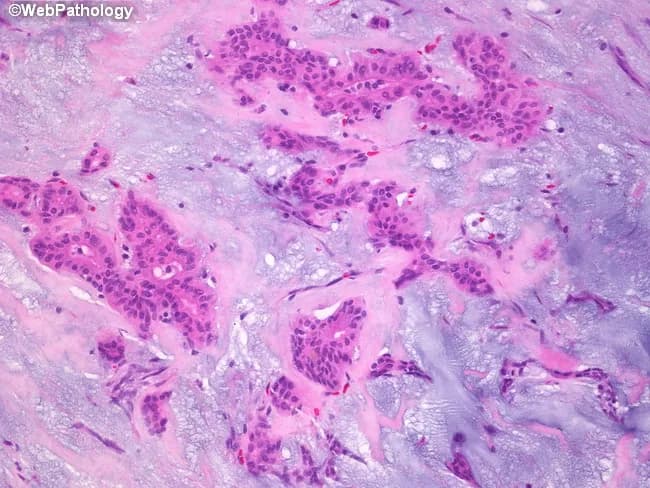 Pleomorphic adenoma histology, parotid salivary gland, examined by bright-field microscopy on Hematoxylin and Eosin stained sections. Imaging modality: Light microscopy; technique: Hematoxylin and Eosin staining. The sample reveals a classic biphasic neoplasm comprising epithelial ductal structures and myoepithelial cells embedded in an abundant stromal backdrop. Epithelial components form cords, ducts, and small island formations lined by cuboidal to columnar cells with eosinophilic cytoplasm and hyperchromatic nuclei. Intermixed myoepithelial cells display plasmacytoid or spindle morphologies, often surrounding epithelial elements. The stroma is a prominent feature, ranging from basophilic, myxoid to more eosinophilic, hyalinized areas. The myxoid matrix is rich in glycosaminoglycans and imparts a loose, gelatinous appearance, while hyalinized zones contribute dense eosinophilic bands. Overall architecture is often well circumscribed with minimal pleomorphism and low mitotic activity, consistent with benign behavior. Clinical significance includes differentiation from malignant salivary tumors; prognosis is favorable with complete surgical excision. Differential considerations include mucoepidermoid carcinoma, adenoid cystic carcinoma, basal cell adenoma, and Warthin tumor. This image is useful for educational purposes in pathology, otolaryngology, and head-and-neck surgery, illustrating quintessential pleomorphic adenoma features: epithelial and myoepithelial proliferation in a chondromyxoid stroma, with duct-like structures and a variable stromal composition. This histologic pattern aids diagnosis and education.